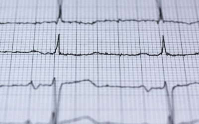 Irregular Heartbeats and Chiropractic